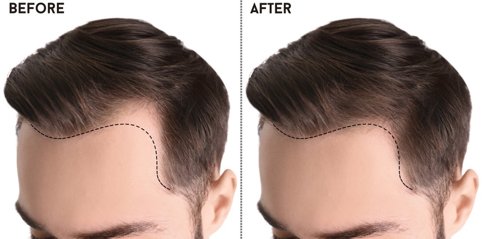raised acne scar treatment