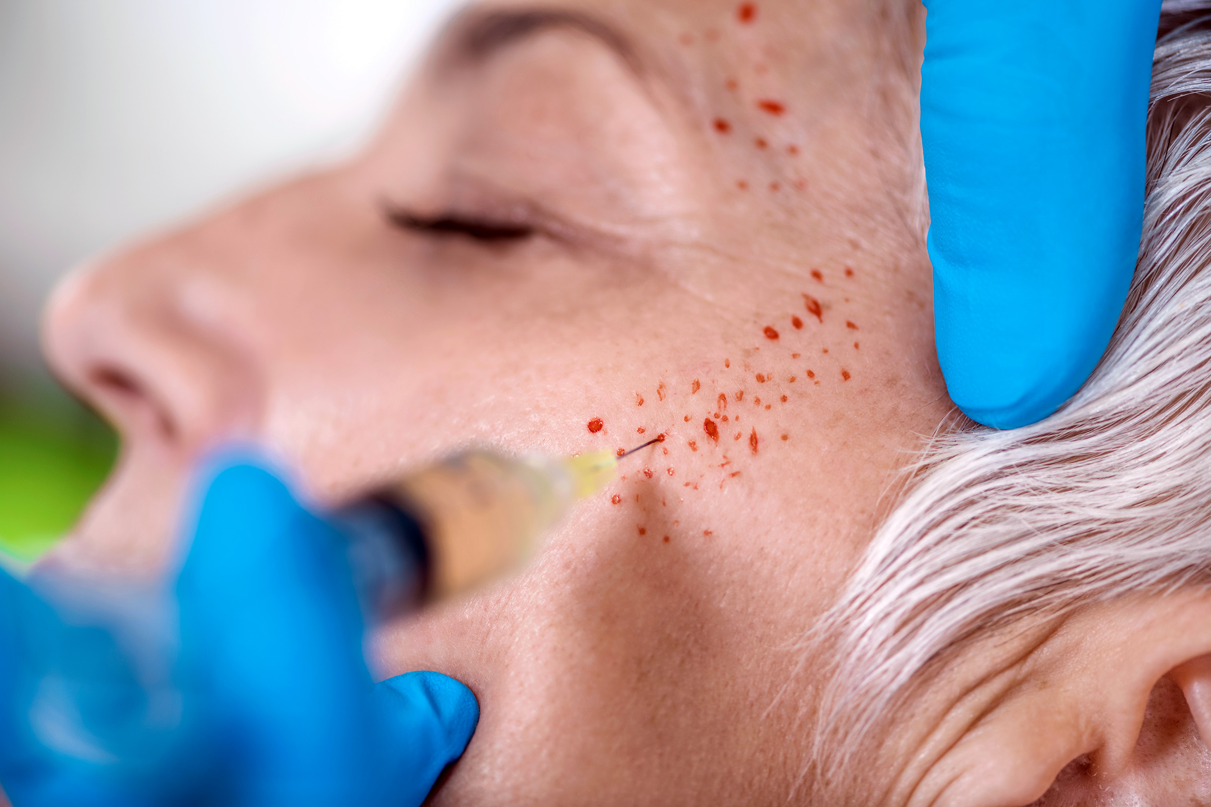 raised acne scar treatment